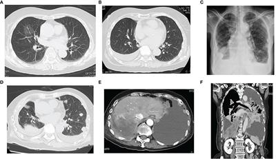 Genomics of Tumor Origin and Characteristics for Adenocarcinoma and Malignant Pleural Mesothelioma: A Case Report